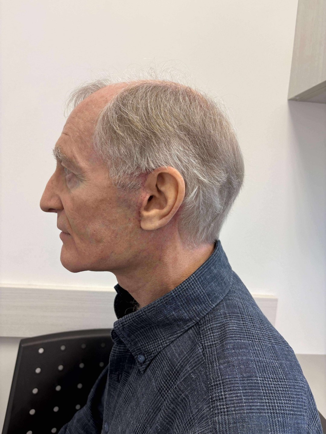 Necklift after surgery front view