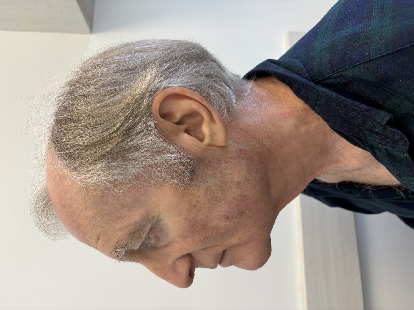 Necklift before surgery left profile view